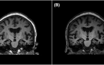 Новый ультрашвидкий протокол МРТ для прискорення діагностикі деменції